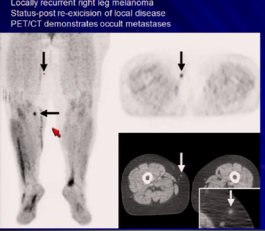 Melanoma Satellite Lesions