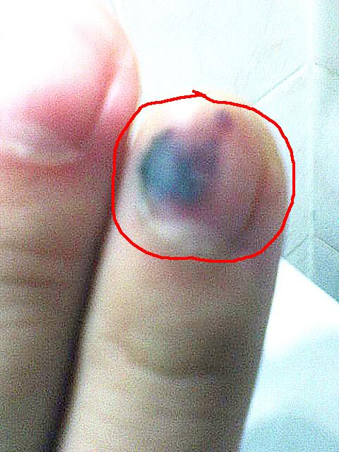 CAN SEE THERE'S A PATCH OF FREAKIN BLOODY SCAR ON MY FINGER NAIL BED