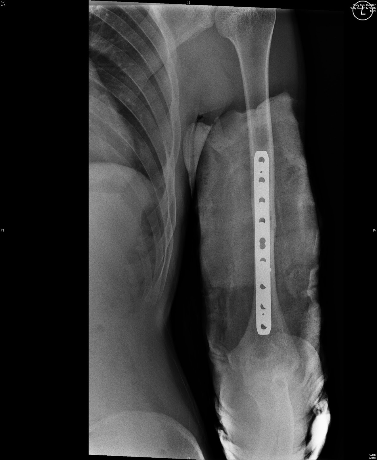 Humerus Fracture Distal Humerus Fracture-4.bp.blogspot.com