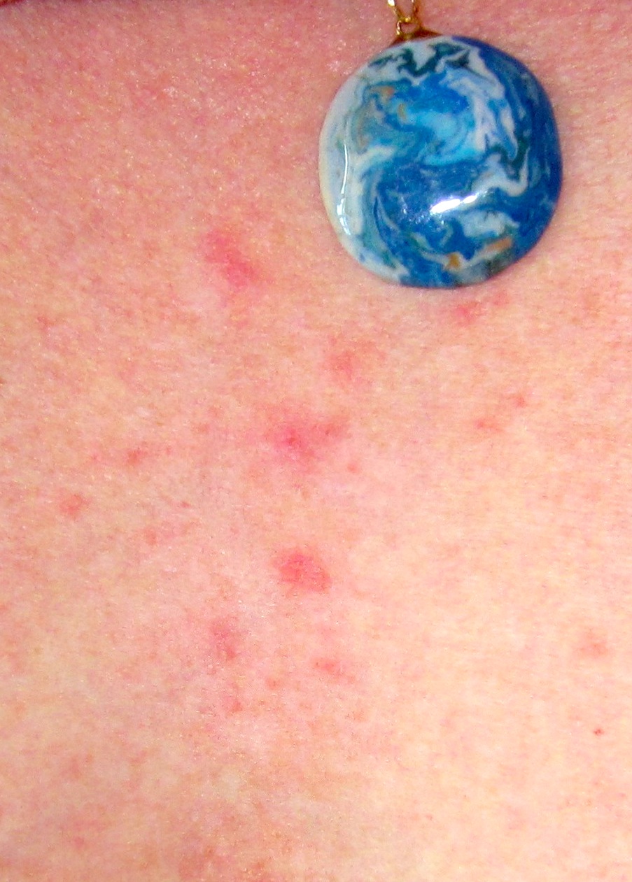 Clindamycin Side Effects Chest Pain
