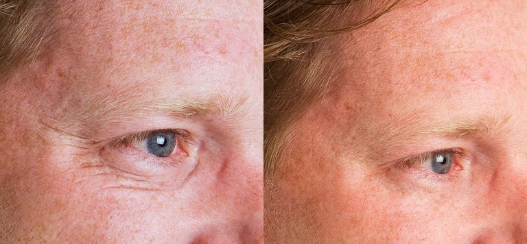 resultaten cosmetische acupunctuur