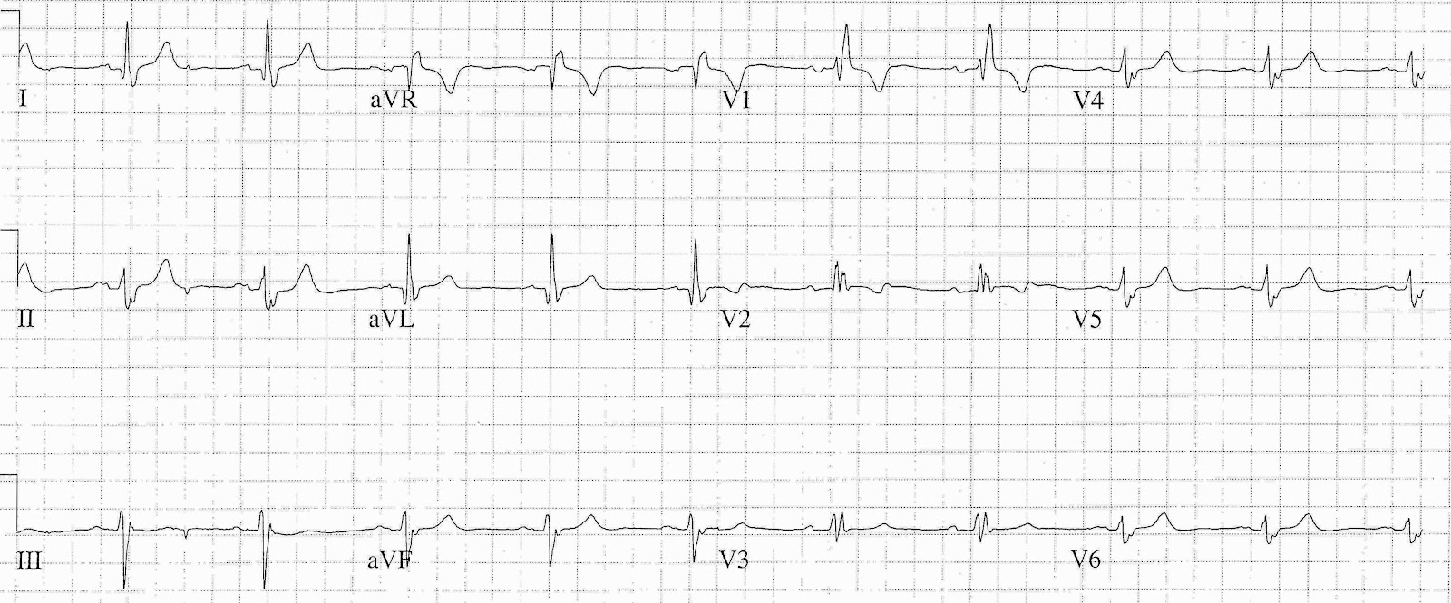 Ecg Myocarditis