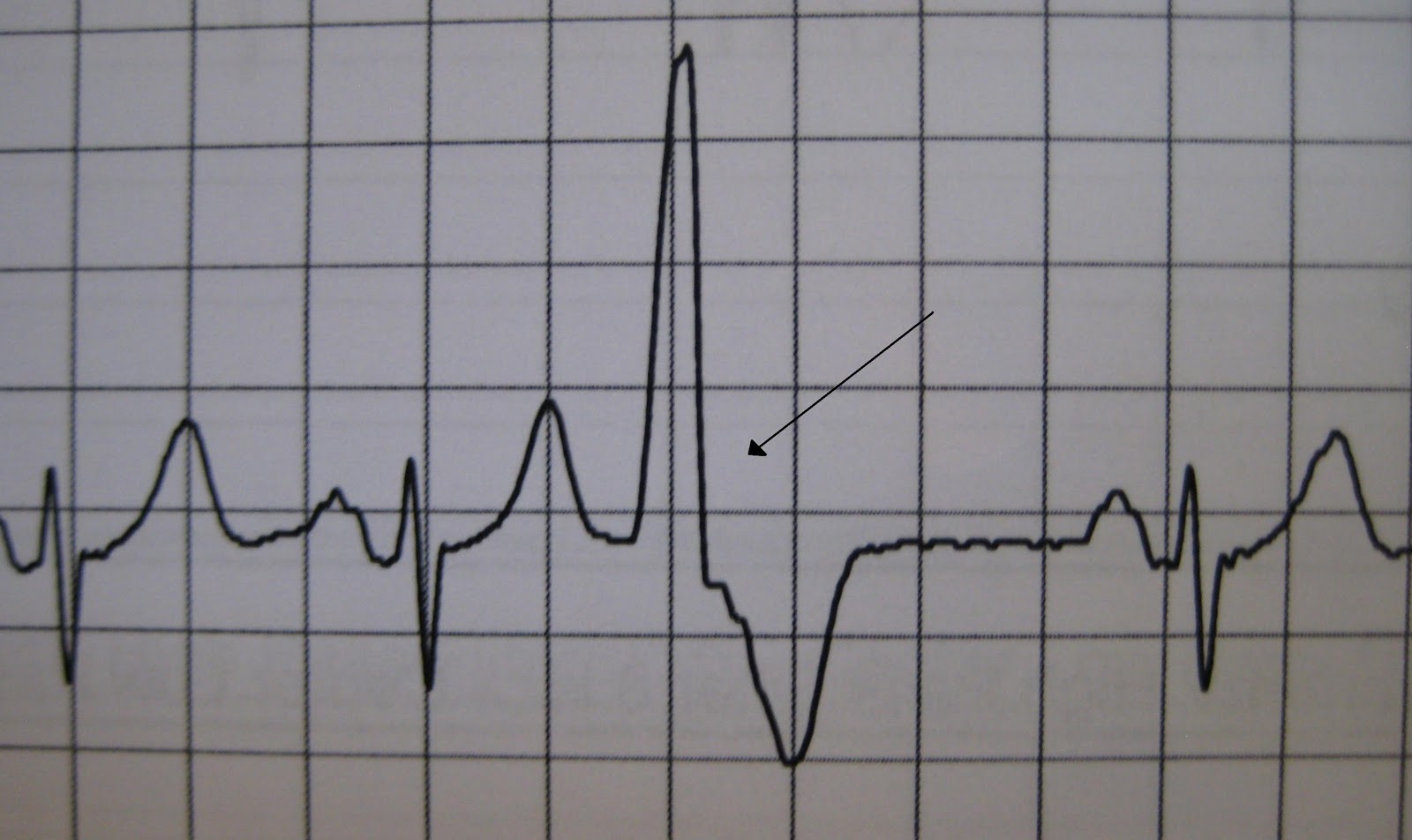 FIREFIGHTER/PARAMEDIC STORIES Heart Rhythms, Part 5 Premature Beats