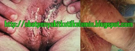 Penyakit Kutil Kelamin Penyakit Kutil Kelamin