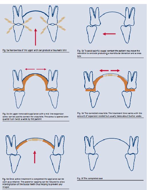 appliance buccal expansion overbite treatment lectures ore nbde mjdf dentistry mfds amount arch occlusion