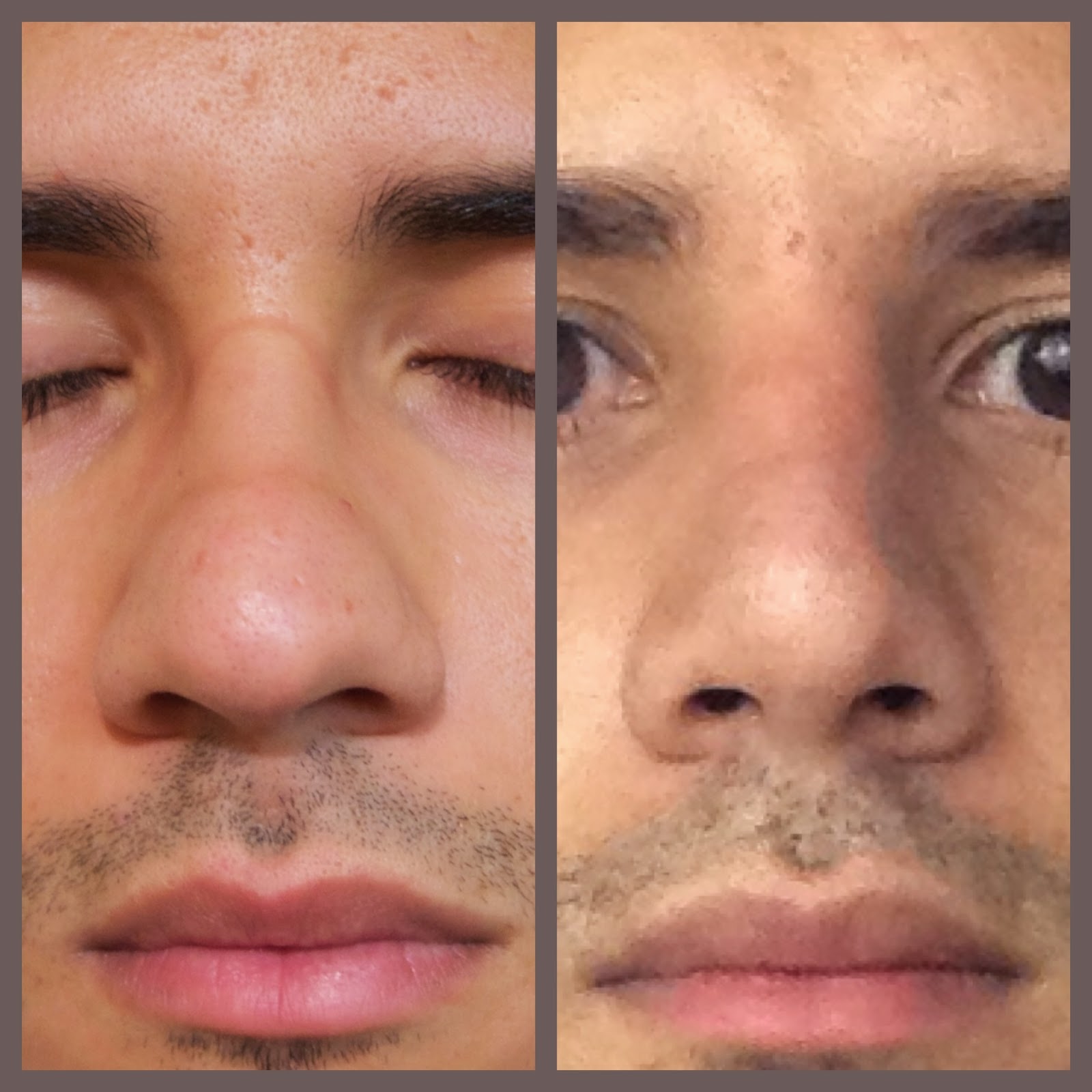 Ma Rhinoplastie Le Retrait De L Attele
