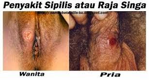 Contoh Obat Kencing Nanah