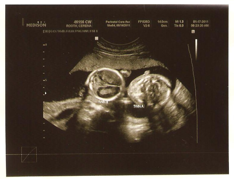 18 week ultrasound 4d 18 week ultrasound 4d