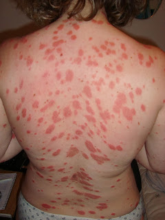 Si es posible a atopicheskom la dermatitis el mijo limpio