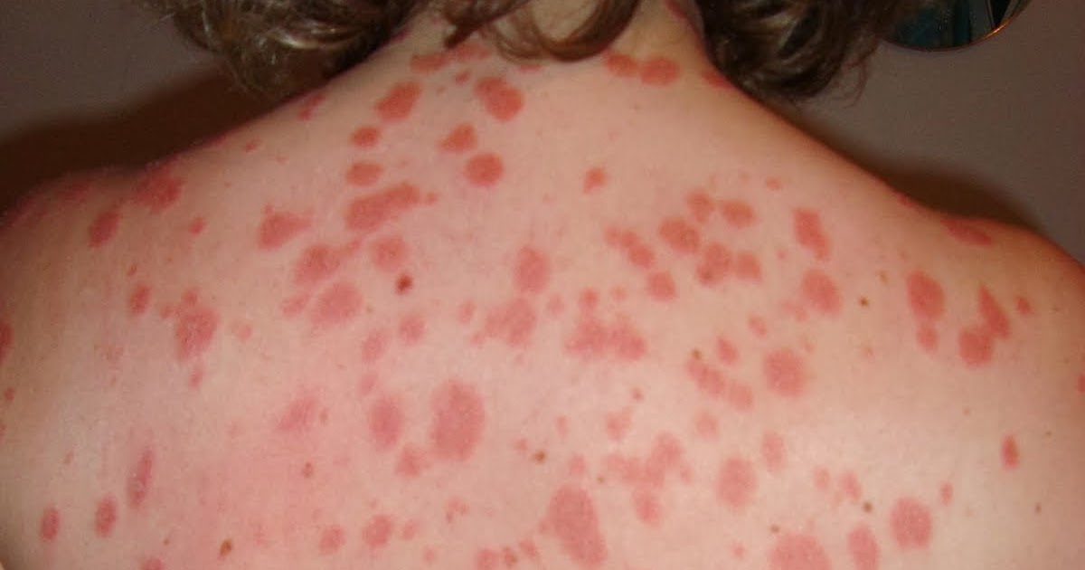 Difundido blyashechnyy la psoriasis el tratamiento