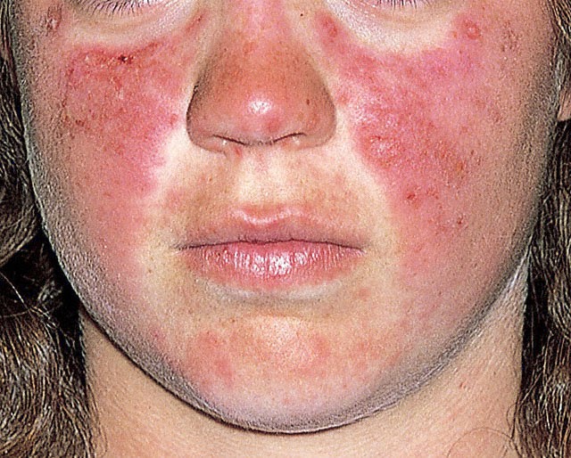 Scarlet Letters, dealing with vascular rosacea, face flushing, burning