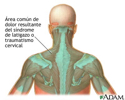 Los síntomas difundido por la osteocondrosis