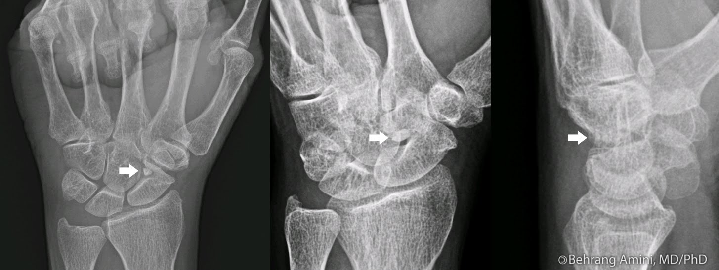 Pathologic Fracture-4.bp.blogspot.com Os Carpi Centrale