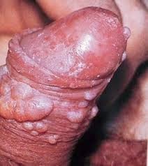 penyakit herpes penyakit herpes