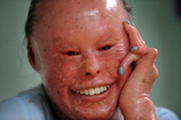 Nusrit+Nelly+Shaheen+Born+1984 Nusrit "Nelly" Shaheen, is the oldest known survivor suffering with ...