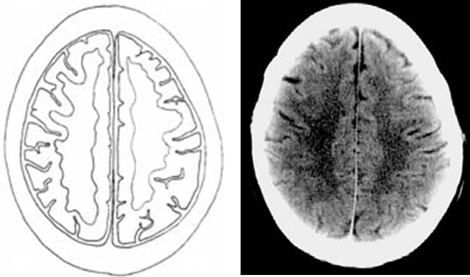 ct head anatomy lobes