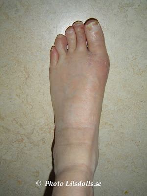 hallux valgus, halluxvalgus-operation, efter op