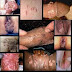 Pusat Penjualan Obat Kutil Kelamin thumbnail