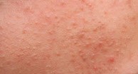 picture of Acne