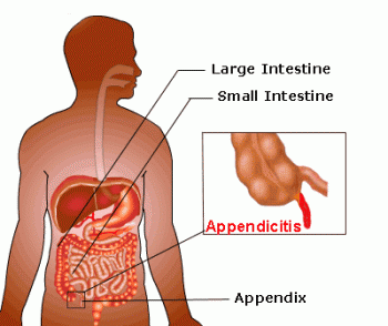 Not tell Appendicitis in adult Advise you Appendicitis in adult sorry, that