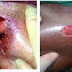 Obat Wasir Dalam Ampuh thumbnail