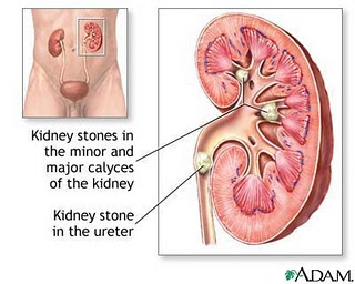 Batu Karang premium beautiful corset membantu mencegah kanser payudara, rahim dan otak dan batu karang atau renal stone