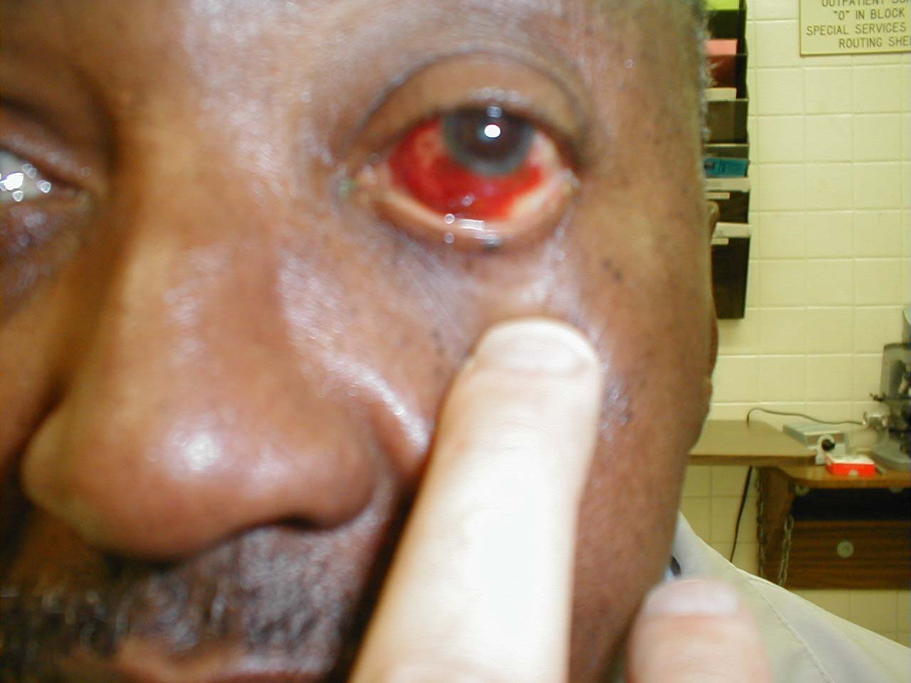 Subconjunctival Hemorrhage Photos