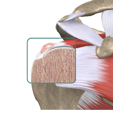 Patologias sobre Tendinite Calcária