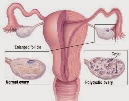 Cyst Disease Symptoms In Women Cyst Disease Symptoms In Women