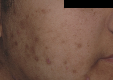 Como reducir las pecas rojo