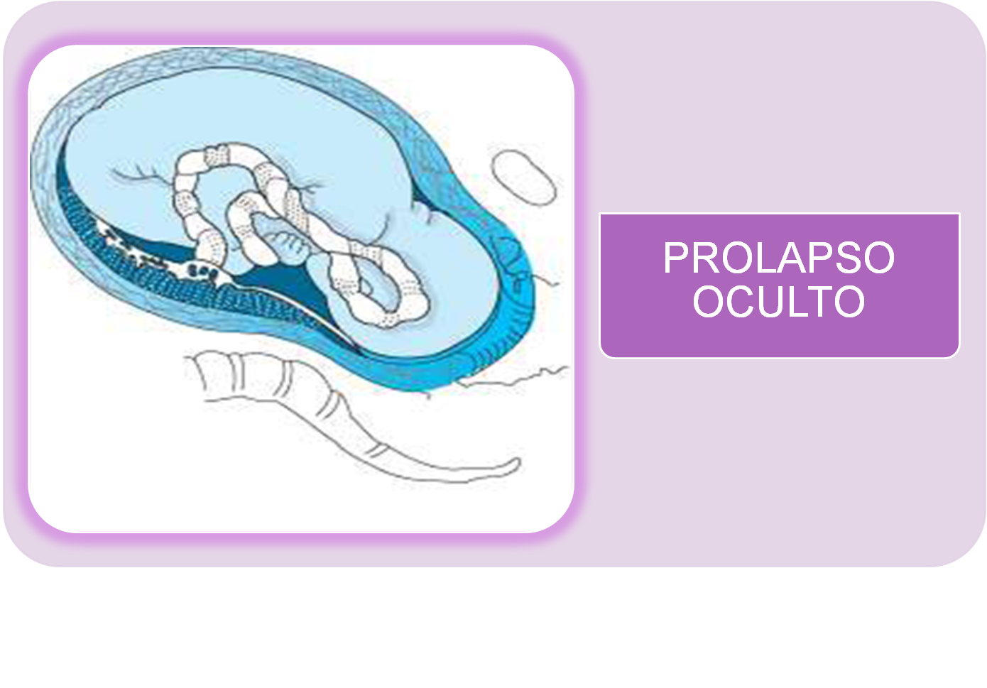 PROLAPSO DE CORDÓN "Obstetricia I"