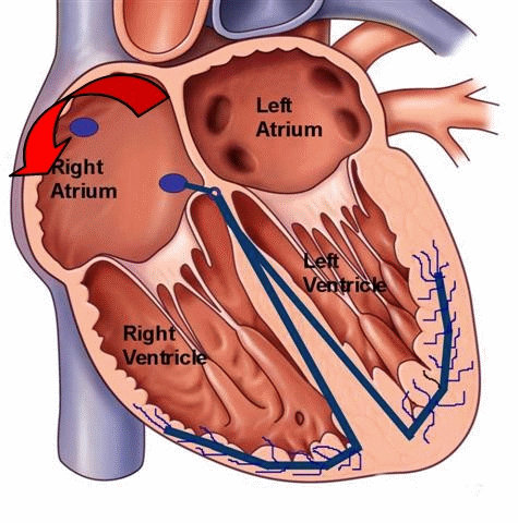 Atrial Flutter Atrial Flutter