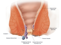hemorrhoid fast and Natural Treatment hemorrhoid fast and Natural Treatment