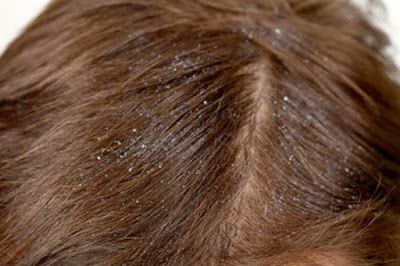Natural Hair Treatments for Dry Scalp