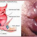 Obat Ambeien Paling Ampuh thumbnail