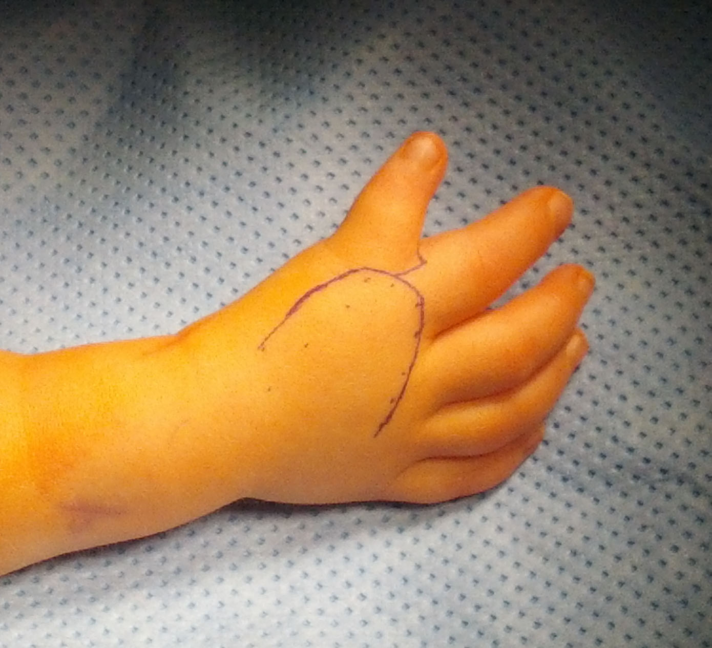 Not the Typical Thumb and Wrist Congenital Hand and Arm Differences