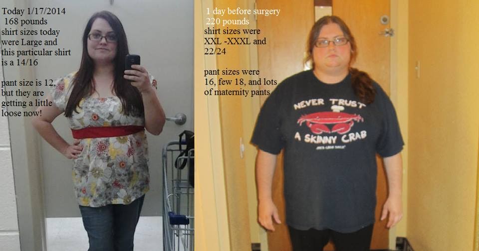 Duodenal Switch Weight Loss Surgery In Mexico Weight Loss Terms