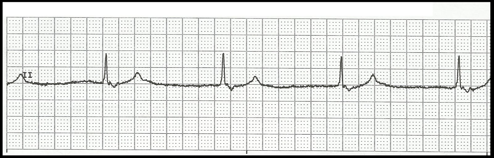 Float Nurse Unstable Bradycardia Part 1 (Betablocker toxicity)