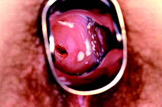 brown vaginal discharge, brown vaginal discharge, what is brown vaginal discharge, brown vaginal discharge, brown vaginal discharge, brown discharge vaginal, vaginal discharge brown, light brown discharge, dark discharge, vaginal odour, smelly vagina, discharge causes, vaginal bacteria, vaginal burning, ovulation discharge, thick white discharge, symptoms discharge, symptoms of discharge, brown discharge before period, vaginal swelling, white vaginal discharge, vaginal discharge white, what is white vaginal discharge, vaginal brown discharge, white creamy discharge, milky white discharge, white milky discharge, vaginal spotting, brown discharge in early pregnancy, yellow vaginal discharge, vaginal discharge yellow, discharge during early pregnancy, brownish vaginal discharge, vaginal discharge odor, foul smelling discharge, normal vaginal birth, white discharge from vagina, periods brown discharge, genital discharge, vaginal soreness