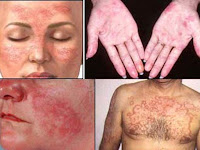 Mengenal Penyakit Lupus Lebih Dekat