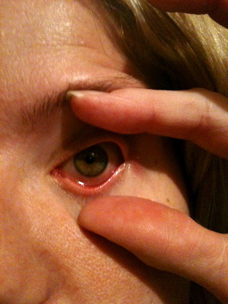 The Wandering Drays Pinkeye, Poop, and Puking...OH MY!