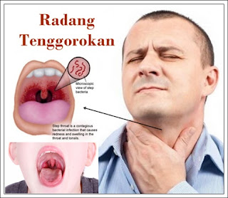 Cara Mengobati Radang Tenggorokan Paling Ampuh Cara Mengobati Radang Tenggorokan Paling Ampuh