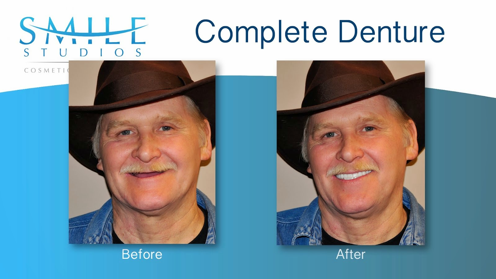 Complete Dentures