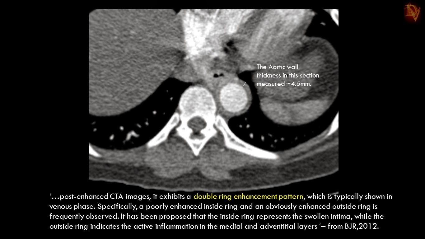 Ultimate Radiology TAKAYASU ARTERITIS A less common presentation
