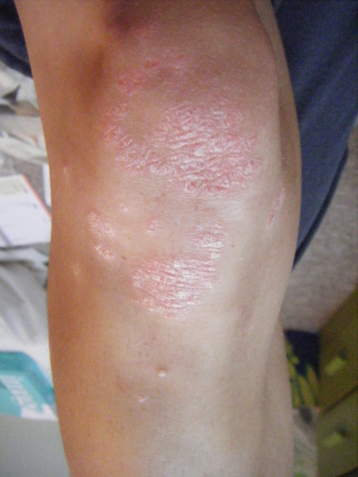 Food for Consciousness healing psoriasis and magnesium baths