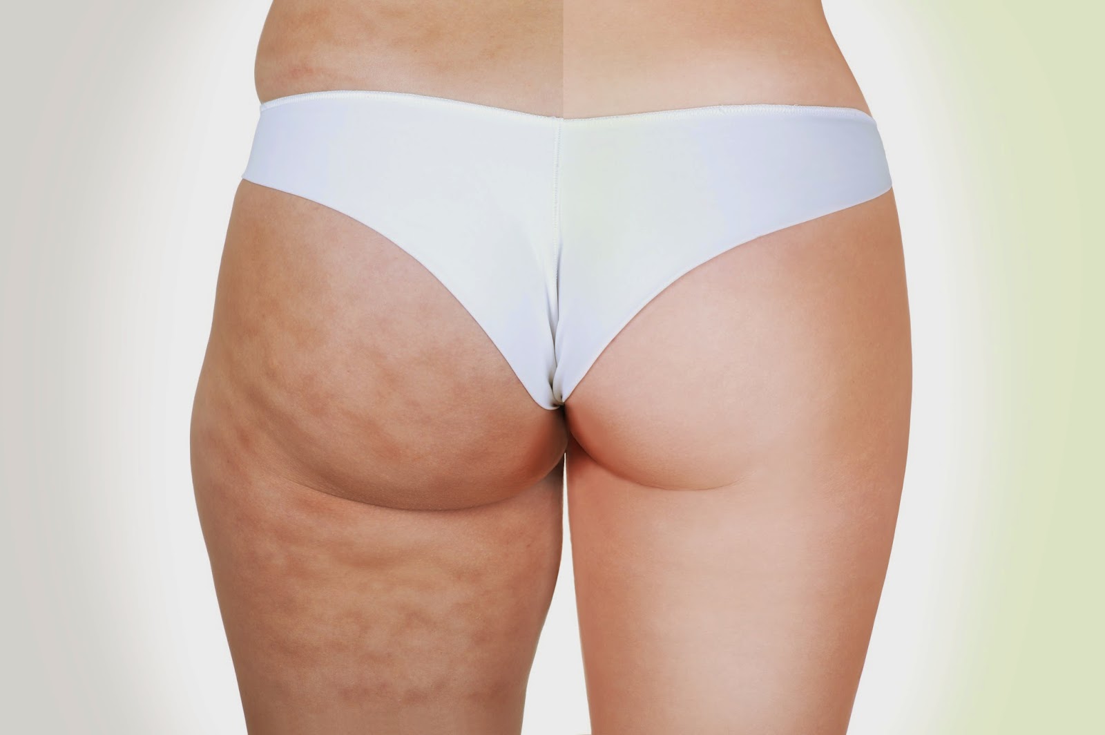 cellulite, before after, tips
