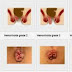 Ambeclear Obat Wasir Paling Ampuh thumbnail