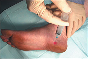 Steroid injection into knee joint