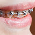 الأضرار المحتملة عند عمل تقويم الأسنان