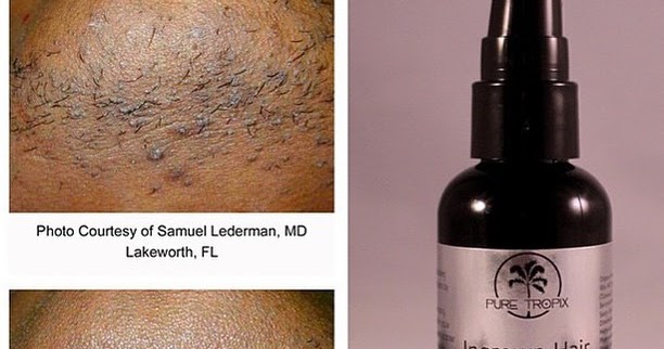 Puretropix Ingrown Hair Prevention